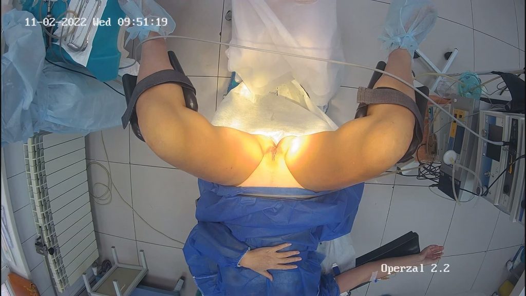 Gyno surgery hidden cam 8