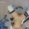 Gyno surgery hidden cam 10