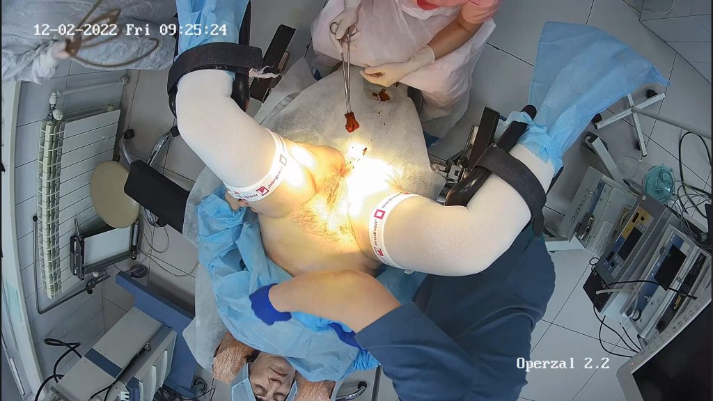 Gyno surgery hidden cam 21