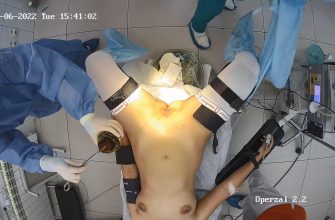 Gyno surgery hidden cam 24