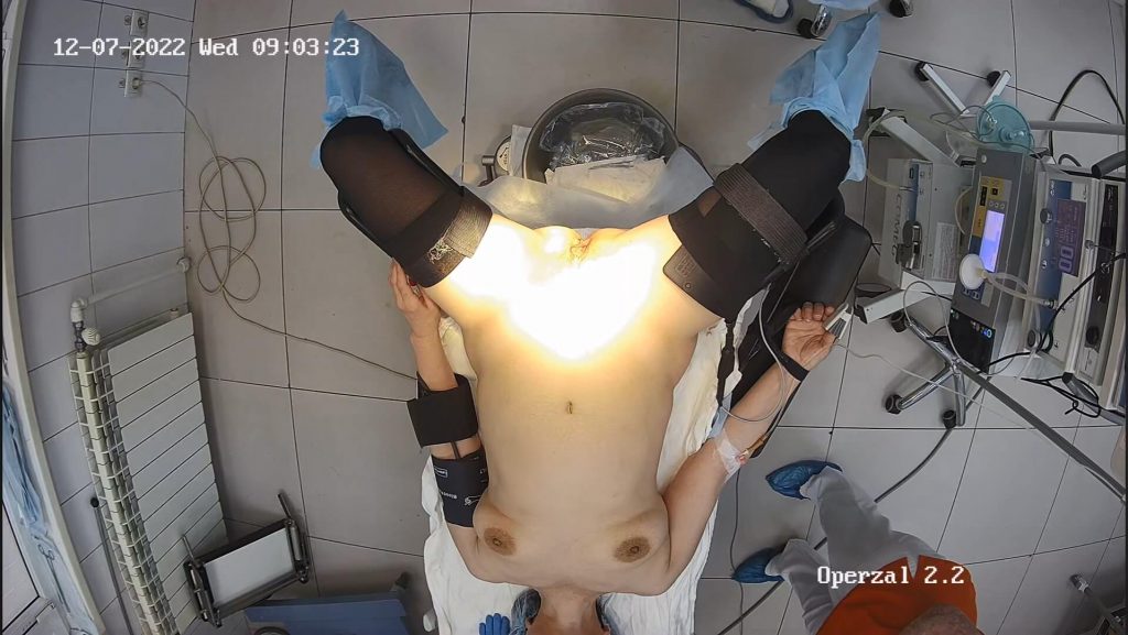 Gyno surgery hidden cam 26