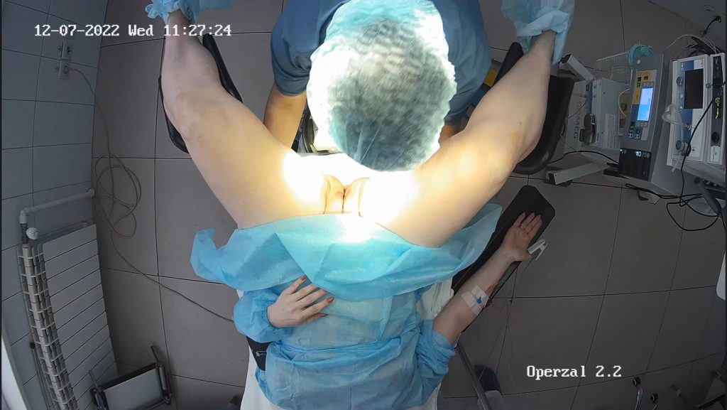 Gyno surgery hidden cam 27