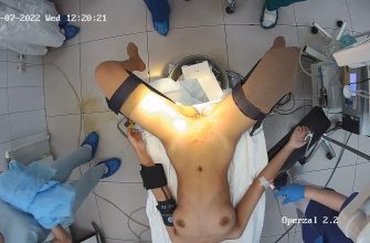 Gyno surgery hidden cam 27