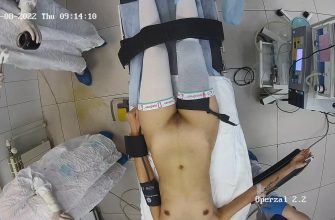 Gyno surgery hidden cam 31